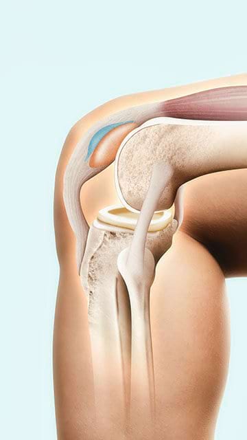 tratament articular fără cartilaj cel mai bun remediu pentru ligamente și articulații